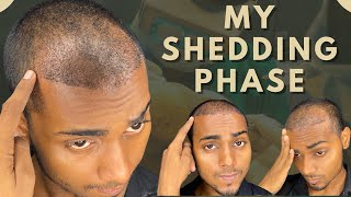 Shedding Phase  My Shedding Phase after 20 Days of Hair Transplant  Krishna Yadav Hair Transplant [upl. by Edylc]