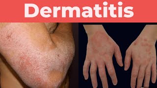 What is Dermatitis A complete guide about Dermatitis [upl. by Inaflahk203]