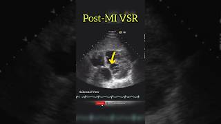 4 days post MI with dyspnea and hypotension  Echo revealed Ventricular Septal Rupture [upl. by Nel]