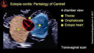 Fetal echocardiography at 1113 weeks Ectopia Cordis in Pentalogy of Cantrell [upl. by Windzer525]