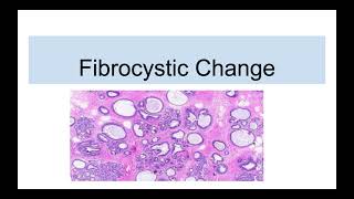 Fibrocystic Disease of Breast [upl. by Attirehs]