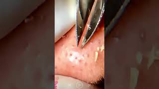 Skincare  Blackheads Removal 287 tweezers skincare blackheads blackheads [upl. by Enyallij833]