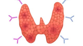 Endocrine Pathology 6 Major Thyroiditis de Quervain Subacute LymphocyticRiedal Thyroiditis [upl. by Wyck544]