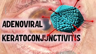 VIRAL CONJUNCTIVITIS  Ultimate Guide to Recognising Clinical Presentations [upl. by Kaleena]