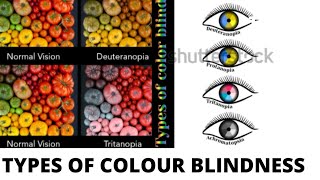 TYPES OF COLOUR BLINDNESS  PROTANOPIA TRITANOPIA DEUTERANOPIA [upl. by Kurt200]