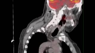 PETCT Scan Diagnostic Radiology Mercy Medical Center Canton Ohio cantonmercyorg [upl. by Laersi]