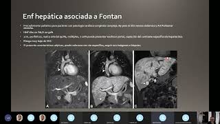 Hiperplasia Nodular Focal Imitadores [upl. by Aryc]