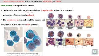 Pathology Hematology  58  Megaloblastic anemia  1 [upl. by Waldman101]