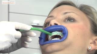 Weiße Zähne durch Bleaching  Zahnaufhellung  Zahnarzt Gundelfingen  Smile Professionals [upl. by Yvor]