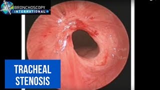 BronchAtlas Morphology of Tracheal Stenosis [upl. by Eelam]