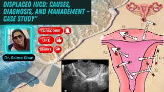 Displaced IUCD Causes Diagnosis and Management – Case Study healthytips DrSaimakhan [upl. by Llyrpa]