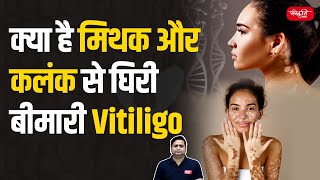 Vitiligo Skin Disease  Myths Stigma and Facts About This Skin Condition  UPSC [upl. by Fusuy663]