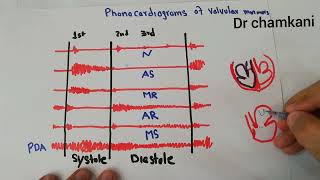 CVS 233  Phonocardiograms of valvular murmurs  Aortic and mitral [upl. by Eeclehc]