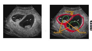 Anatomy of monochorionic diamniotic twin pregnancy twin anatomy pregnancy twinpregnancy [upl. by Hnilym]