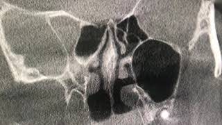 Deviated Nasal Septum explained with Cone Beam CT scan [upl. by Casper]