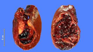 Hepatic embryonal sarcoma presented as a cystic mass [upl. by Dor]