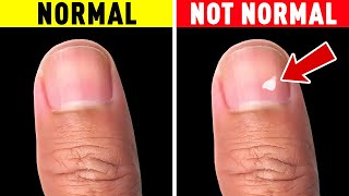 The Truth About White Spots on Your Nails [upl. by Mallis]