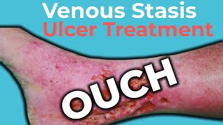 Venous Stasis Ulcer Treatment  Wound Care OC [upl. by Fidela]