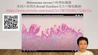 sebaceous nevusの病理組織像の解説 [upl. by Brunhilde363]