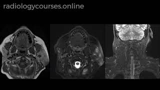 Acute Sialadenitis [upl. by Browning769]