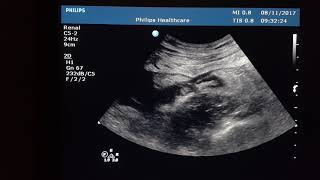 RIF Abscess vs mass Sonography [upl. by Obaza]