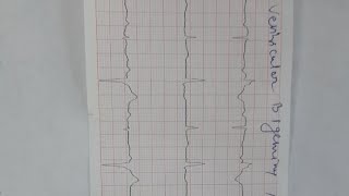 ventricular bigeminy and trigeminy [upl. by Hanni]