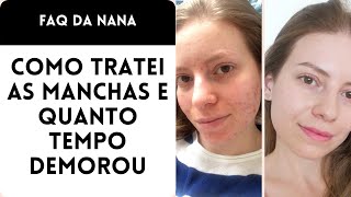 Opções de Tratamento para MANCHAS DE ACNE  Quanto tempo demora produtos e procedimentos [upl. by Parsifal564]