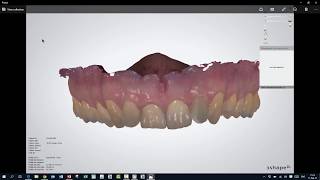 3Shape Ortho Analyzer  How to Use Virtual Setup Animation [upl. by Eelatsyrc]