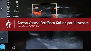 Acesso Venoso Periférico Guiado por Ultrassom  demonstração de procedimento em simulador [upl. by Romona684]