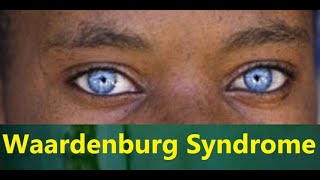 Waardenburg Syndrome [upl. by Theresa]