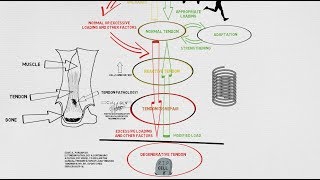 Tendinopathy Continuum and Update [upl. by Eitsyrhc414]