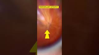 Peripapillary ATROPHY myopic fundii [upl. by Baptista]