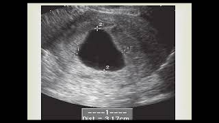 Ultrasound diagnosis of non viable early pregnancy [upl. by Shanan]