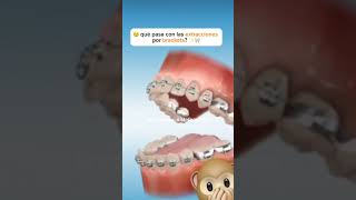 premolar extraction for orthodontic treatment ортодонтия kieferorthopädie ortodonzia orthodontie [upl. by Waers440]