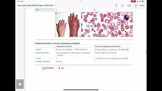 leukemoid reaction vs cml haematology 89 First Aid USMLE Step 1 in UrduHindi [upl. by Airdna810]