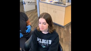 Braces Removal Time lapse  Braces and Invisalign  Omaha NE [upl. by Ronyam128]