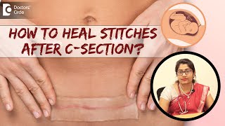 6 Tips to Take Care of Stitches amp Heal Fast After CSection DrSupritha Rangaswamy Doctors Circle [upl. by Henley]