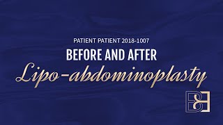 Abdominoplasty for Diastasis Recti and Post Pregnancy Patient 20181007 Before amp After [upl. by Schalles]