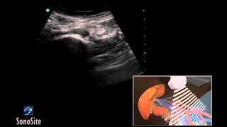 How To Abdominal Aorta Ultrasound 3D Video [upl. by Aikkin]