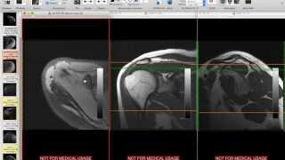 Systematic Interpretation of Shoulder MRI How I do it [upl. by Niko]