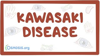 Kawasaki disease  an Osmosis Preview [upl. by Dorian746]