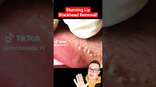 Crazy Painful BLACKHEAD REMOVAL AROUND LIPS  Super Satisfying shorts [upl. by Odidnac174]