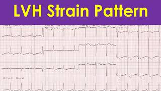 Left Ventricular Hypertrophy with Strain Pattern [upl. by Aeirdna263]