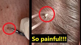 Painful and satisfying ingrown hair compilation  Best TikTok trending content [upl. by Harley754]