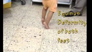 equinus deformity of both feet by Dr Auday Hussain دكتور عدي حسين [upl. by Domingo]