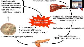 Refeeding Syndrome RFS Prof R K Singh Emergency Medicine SGPGI [upl. by Oakie]