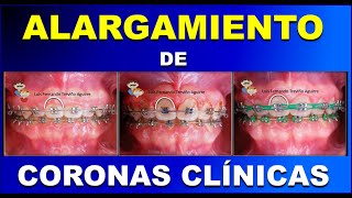 ALARGAMIENTO DE CORONA CLÍNICA CON GINGIVECTOMÍA Y GINGIVOPLASTÍA [upl. by Jorie627]