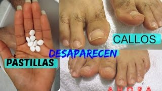 Callos que desaparecen tratamiento caseroRemove callus from feet at home [upl. by Daniele]