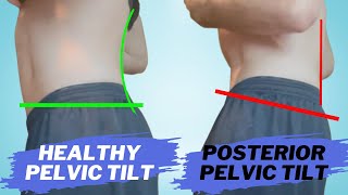 POSTERIOR PELVIC TILT 4STEP FIX [upl. by Pettit]