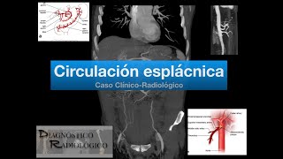 Caso Circulación Colateral Esplácnica [upl. by Lohman3]